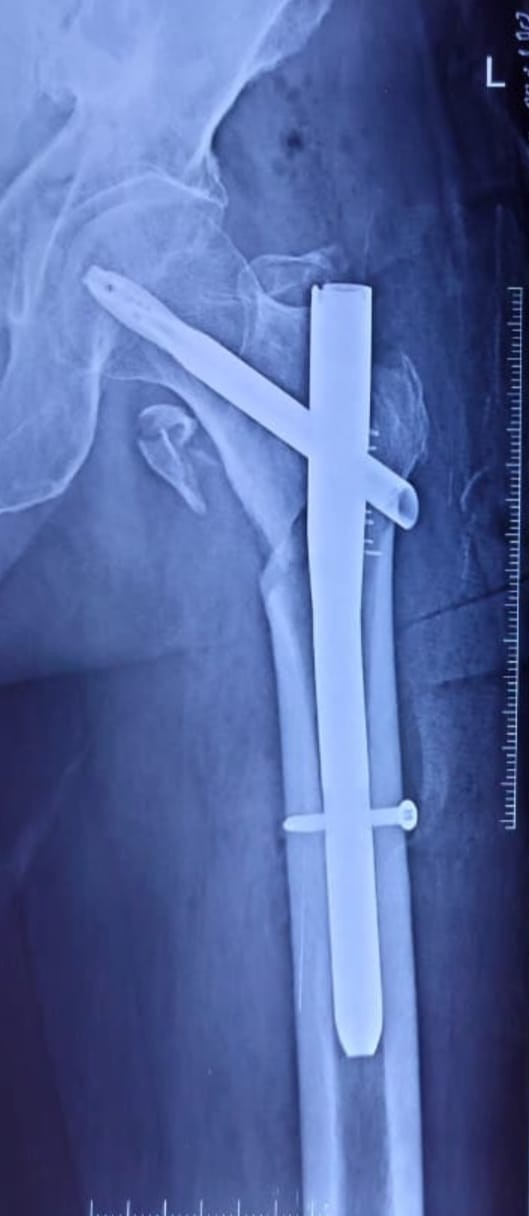 Before fracture management example